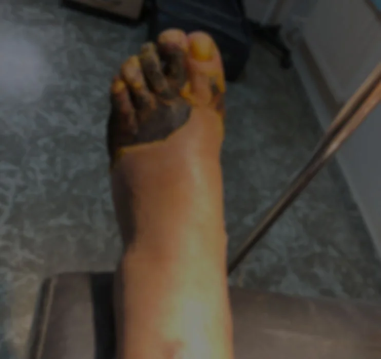 pie_diabetico