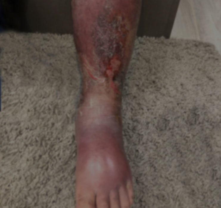 tratamiento_erisipela