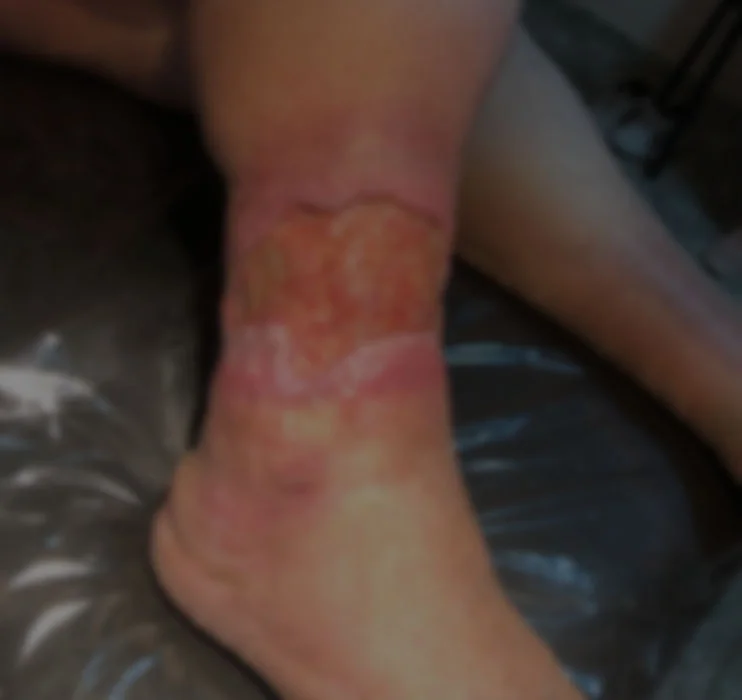tratamiento_ulcera_venosa